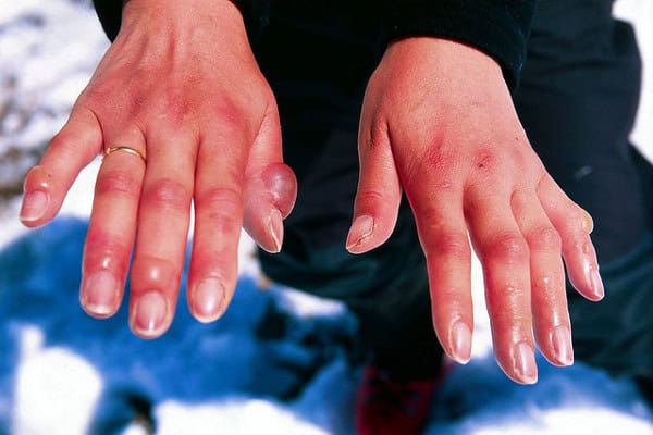 Trekking at High Altitude - Health Challenges You Must Know 2 Hypothermia and Frostbite