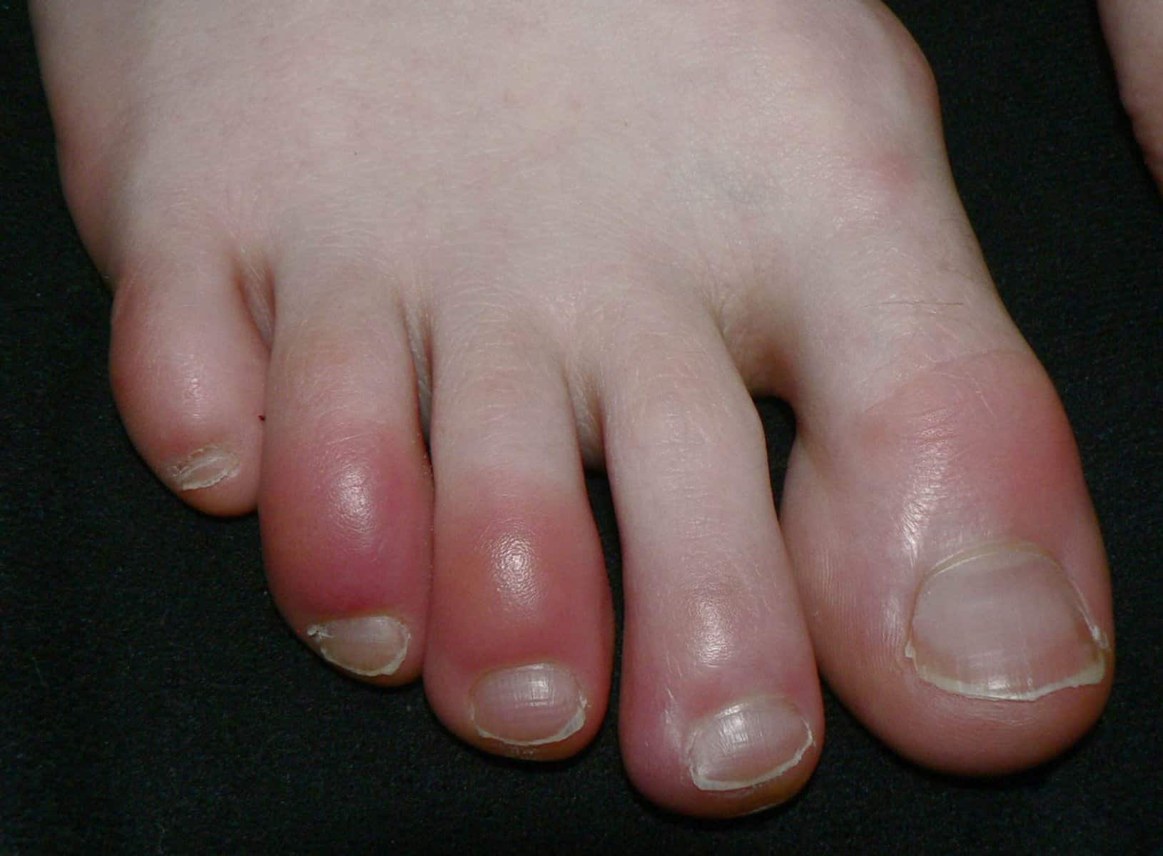 Chilblains: Prevention Tips and Measures 1 Chilblains: Prevention Tips and Measures